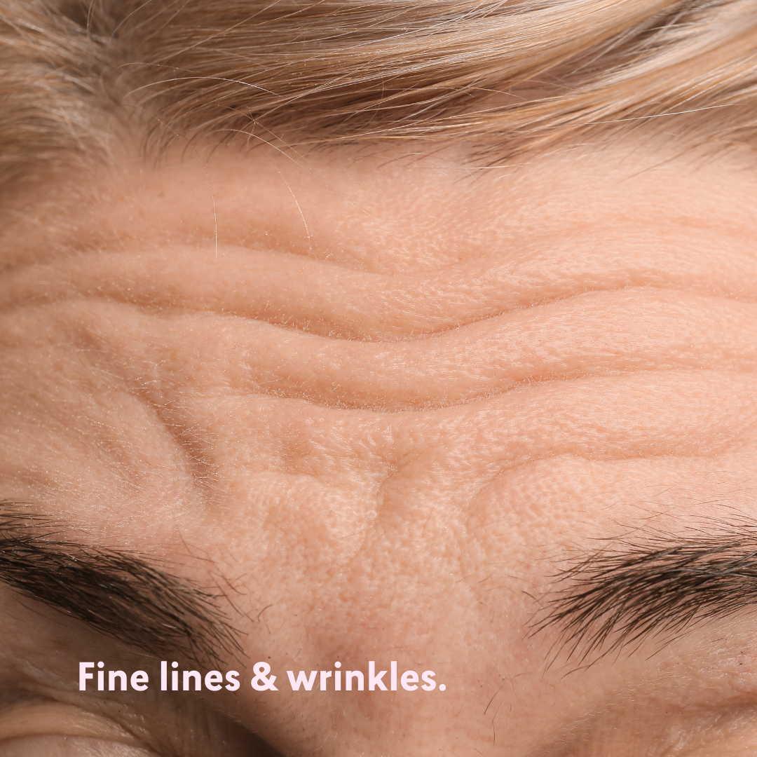 Fine lines & wrinkles. – Facetox