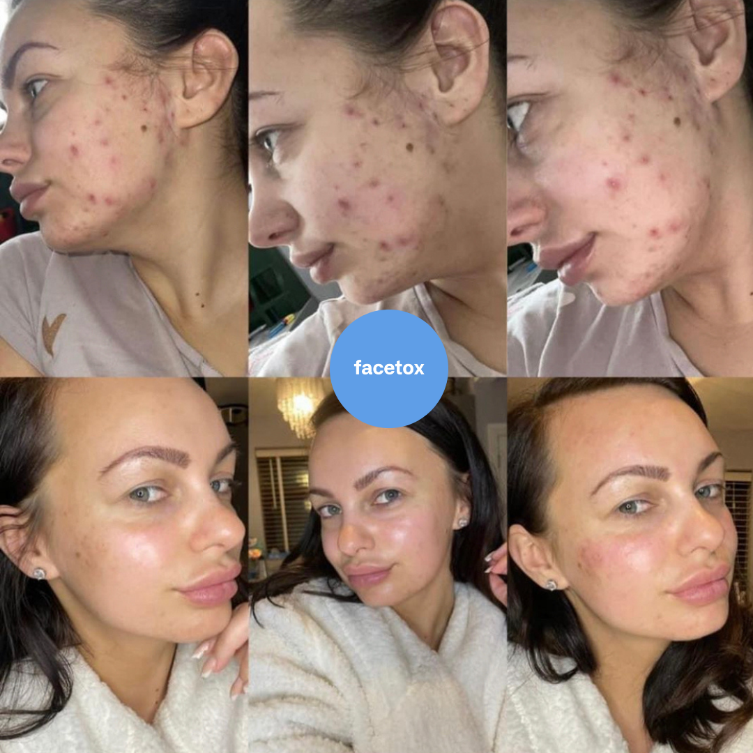 Skin Fix Peel - At Home Chemical Peel