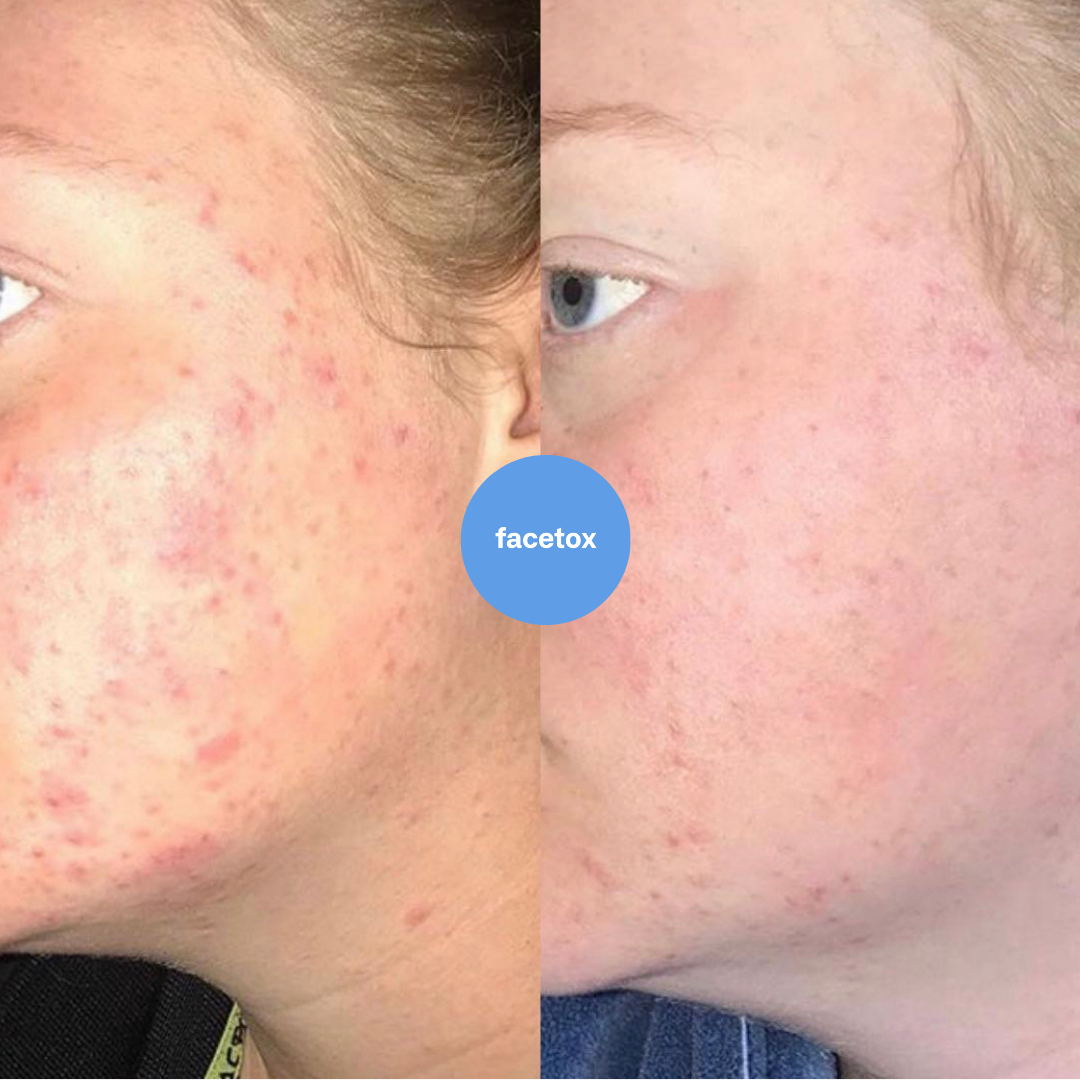 Skin Fix Peel - At Home Chemical Peel