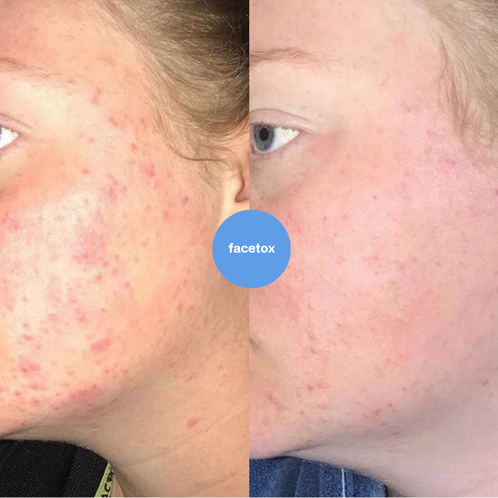 Skin Fix Peel - At Home Chemical Peel