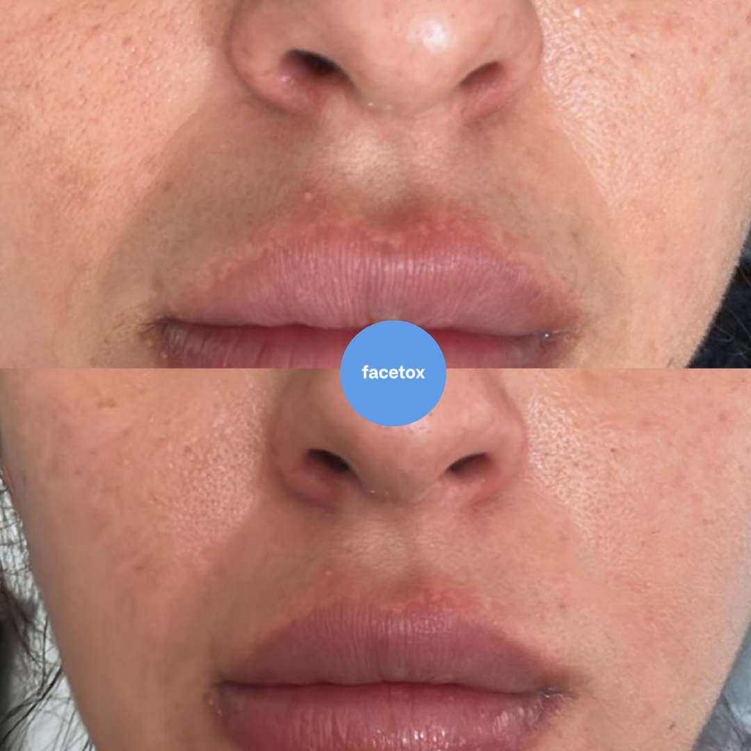 Facetox Mouth + Smile Lines Silicone Patches
