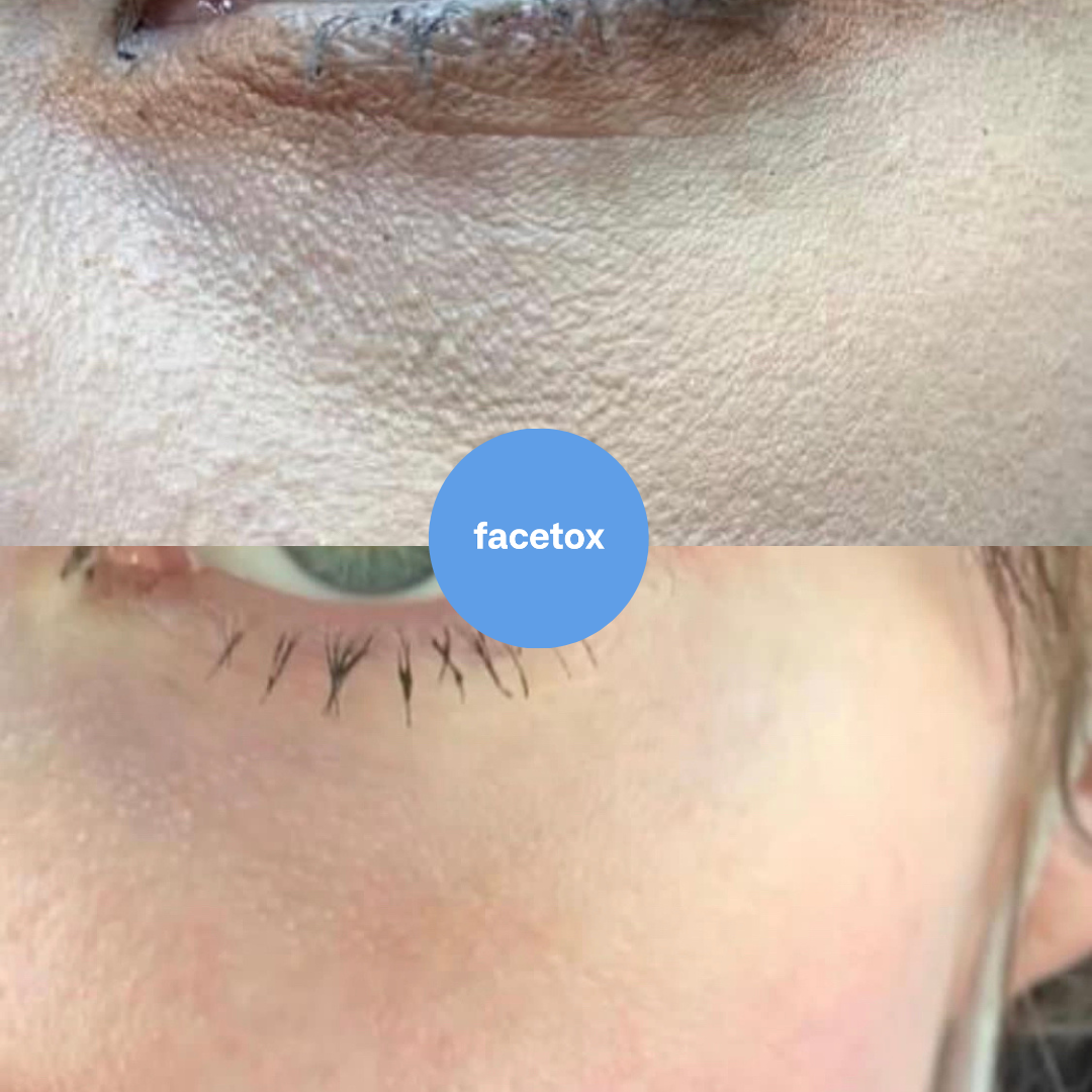 Facetox Anti-Wrinkle Kit