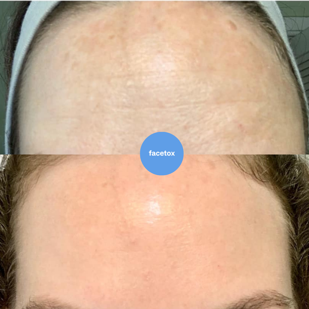 Facetox Forehead + Frown Lines Silicone Wrinkle Patch