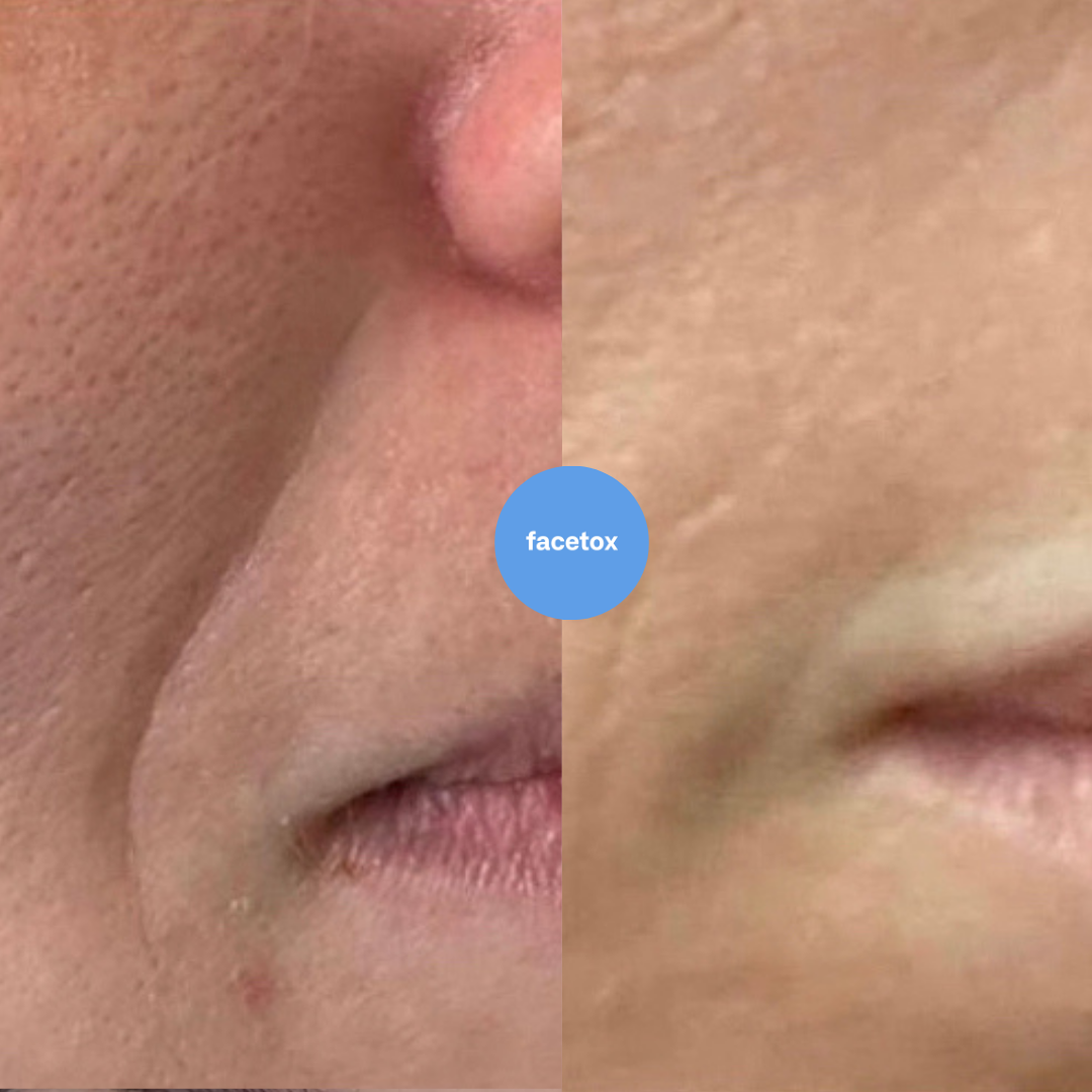 Facetox Anti-Wrinkle Kit