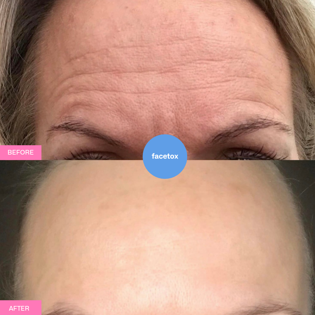 Facetox Forehead + Frown Lines Silicone Wrinkle Patch