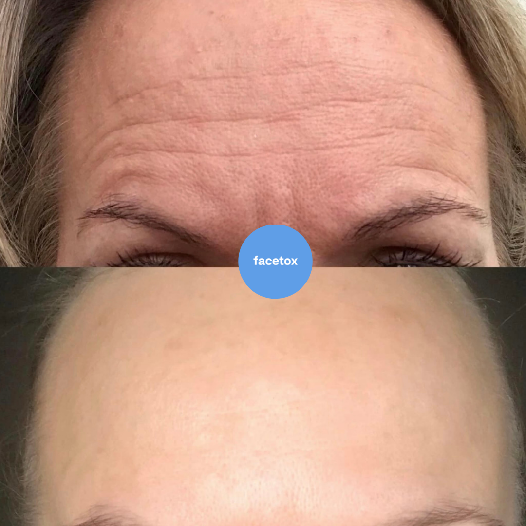 Facetox Forehead + Eyes Silicone Patches