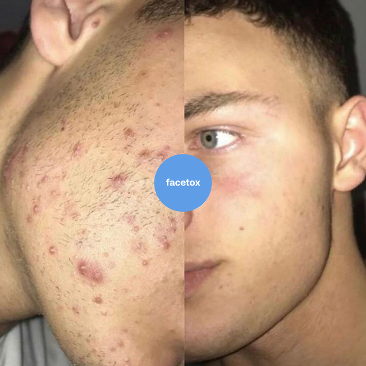 Skin Fix Peel - At Home Chemical Peel